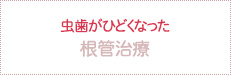 虫歯がひどくなった 根管治療