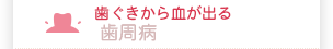 歯ぐきから血が出る 歯周病